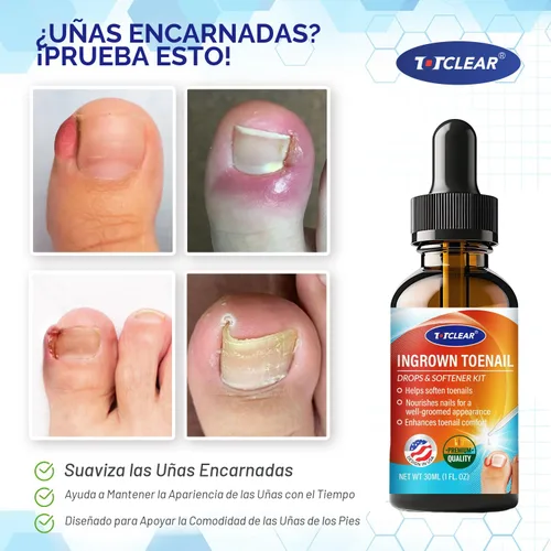 Vista 2 de Alivio de Uñas Encarnadas: Herramienta para Uñas Encarnadas para Hombres Mujeres - Kit de Eliminación de Uñas Encarnadas - Gotas Correctoras de Uñas