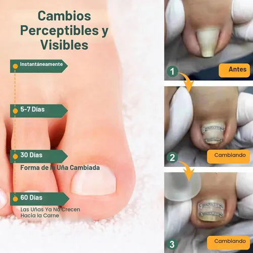 Vista 3 de Corrector de uñas encarnadas de nitinol dual, tratamiento de uñas encarnadas, enderezador de uñas curvas, kit de eliminación de uñas encarnadas