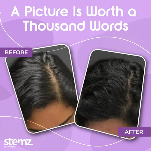 Vista 6 de Stemz - Estimulador de folículos pilosos para mujeres, alternativa natural al minoxidil y al aceite de crecimiento del cabello, péptidos de musgo