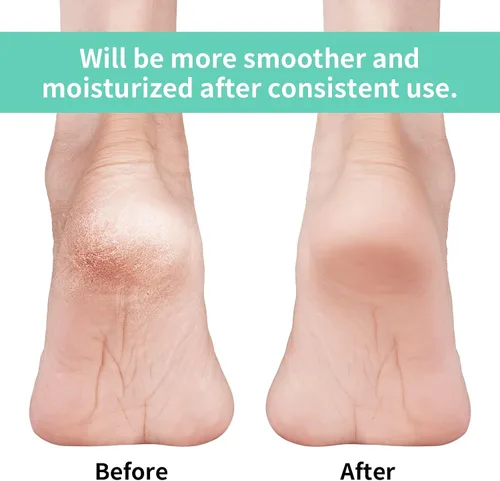 Vista 2 de Vaincre - 4 pares de calcetines de gel hidratantes para talones, para pies secos y agrietados en mujeres, cuidado de pies spa, calcetines sin dedos