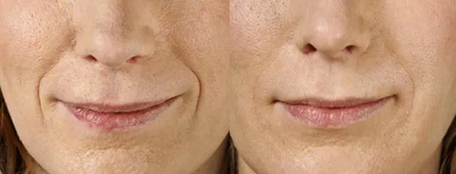 Vista 4 de Magic Serum-No Needle Alternative-BioActive Argireline Peptides Complex Anti-Eexpression Line/Creases Serum-Matrixyl 3000, SNAP-8, Pentapeptide-18