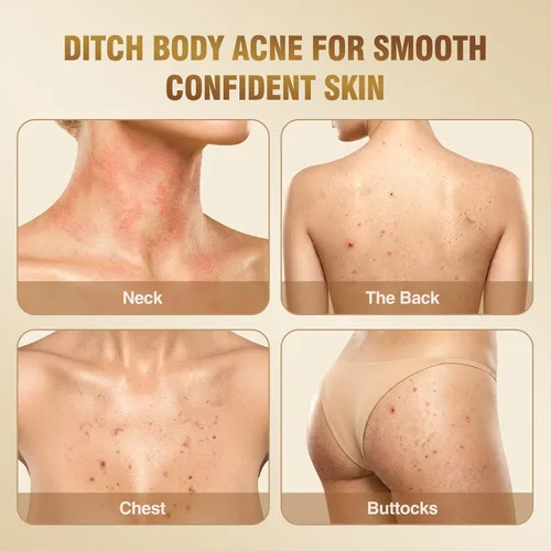 Vista 6 de Solución de suero de ácido salicílico al 2% para la cara: Suero facial exfoliante suave para el acné, puntos negros y poros abiertos y reduce