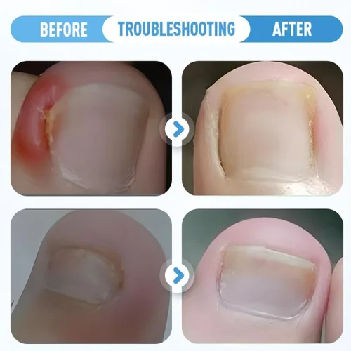 Vista 6 de Juego profesional de uñas encarnadas con tiras transpirables de uñas encarnadas, parche corrector de uñas curvas, kit de herramientas de pedicura