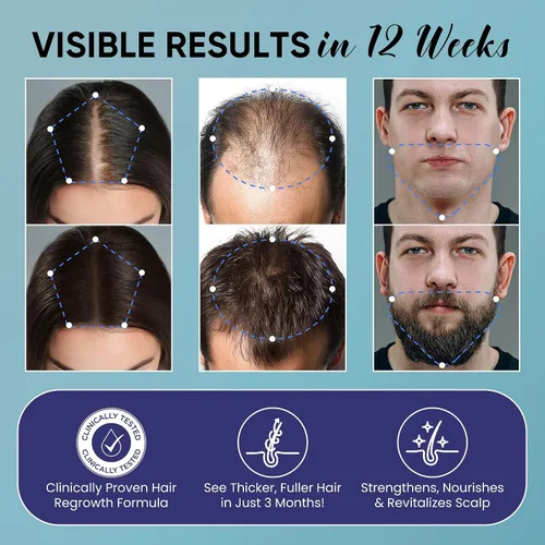 Vista 3 de 5% Minoxidil para hombres y mujeres Kit de spray para el crecimiento