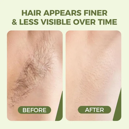 Vista 4 de Cyperus Rotundus Aceite para depilación – Aceite orgánico de rotondo de ciprés prensado en frío para ayudar a reducir la apariencia de cabello