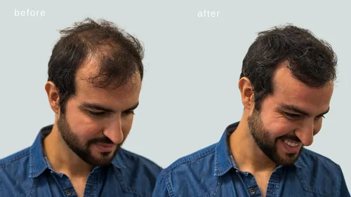 Vista 5 de Fibras capilares voluminizadoras con queratina real para adelgazar el cabello/pérdida de cabello – Dermatológicamente probado y certificado