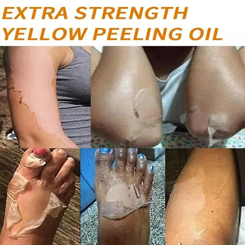 Vista 5 de Generic Aceite pelador amarillo extra fuerte para piel oscura, solución exfoliante para cuerpo, manos, pies y cara, todo