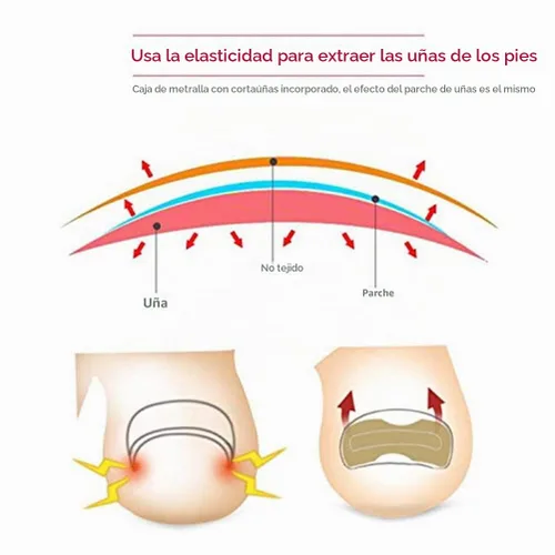 Vista 4 de Parche de corrección de uñas encarnadas, 50 calcomanías de uñas encarnadas sin pegamento para uñas encarnadas curvadas para el cuidado de los pies