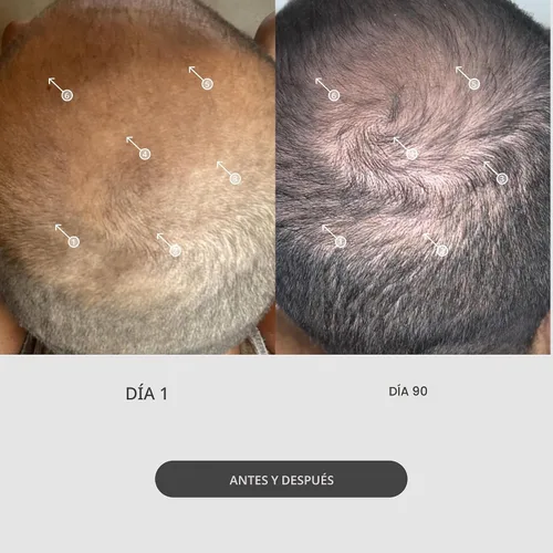 Vista 3 de Sistema de estimulación capilar con microagujas StimuROLLER de DS Labs, 0.25 mm, el empaque puede variar