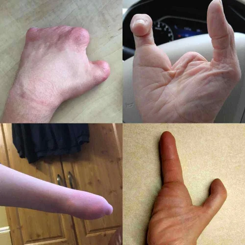 Vista 2 de limb Diferencia Gripping ayuda