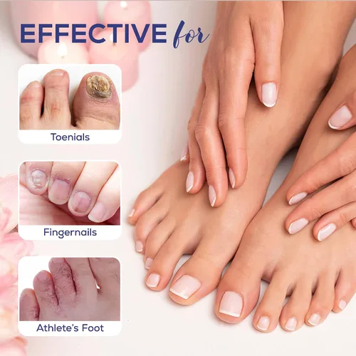 Vista 7 de PHARMBANNER Tratamiento de hongos en las uñas de los pies extra fuerza: 25% de ácido undecilénico renovación de hongos en las uñas y uñas - Kit