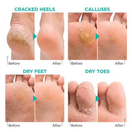 Vista 3 de Máscara exfoliante para pies Lavinso para pies secos y agrietados – Paquete de 2 mascarillas exfoliantes que eliminan la piel muerta y callos