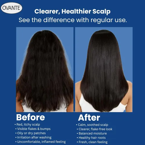 Vista 5 de Solución para foliculitis en champú natural, 6 onzas líquidas