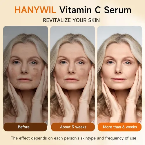 Vista 3 de HANYWIL Suero súper vitamina C con 20% para piel madura, se dirige a la reducción de manchas y arrugas con ácido hialurónico, suero hidratante