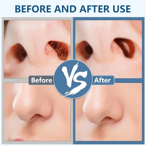 Vista 6 de FXOICMI Cortador de pelo nasal 2 en 1, recortador manual de vello de nariz para hombres y mujeres, removedor de vello nasal de doble cara giratorio