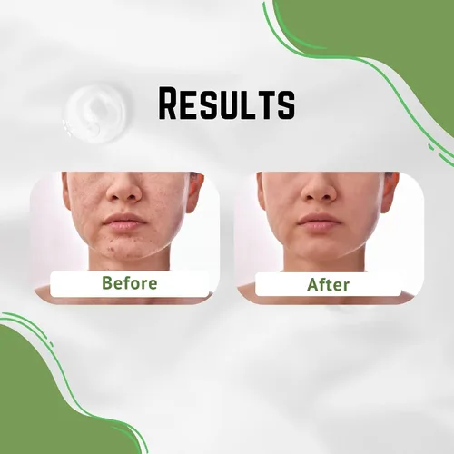 Vista 7 de Crema de aloe vera, corrige marcas oscuras, piel seca y nuevas cicatrices en el cuerpo, crema facial para imperfecciones, reduce la apariencia