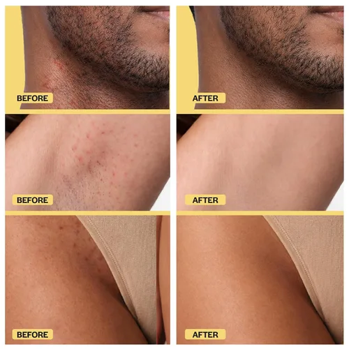 Vista 3 de Base Laboratories Tratamiento para el cabello encarnado – Suero Roller – Suero para suavizar la piel para pelos encarnados y protuberancias