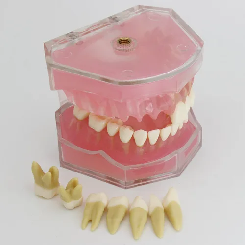 Vista 2 de Modelo de dientes de implante dental con dientes extraíbles para profesionales dentales y estudiantes