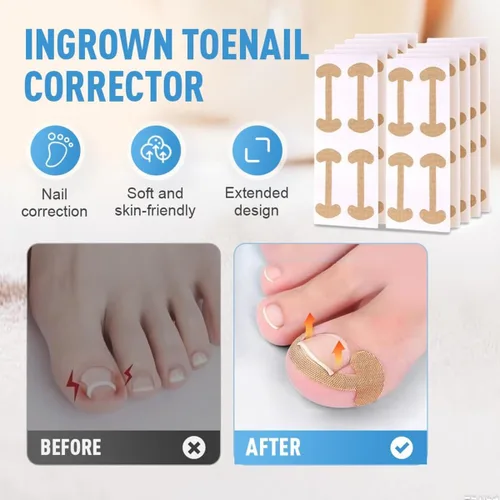 Vista 5 de Juego profesional de uñas encarnadas con tiras transpirables de uñas encarnadas, parche corrector de uñas curvas, kit de herramientas de pedicura