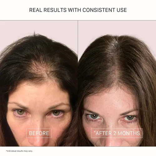 Vista 5 de ACTIIV Recover Tratamiento de Champú Densificante para Mujeres Apoya la apariencia de un cabello más abundante y saludable, apoya la salud