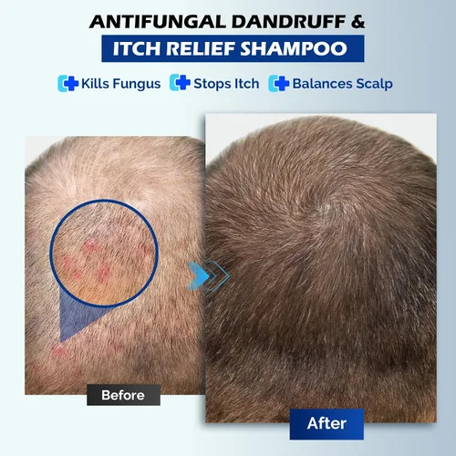 Vista 2 de Champú antifúngico para dermatitis seborreica, foliculitis y psoriasis del cuero cabelludo, champú anticaspa para hombres y mujeres, alivia