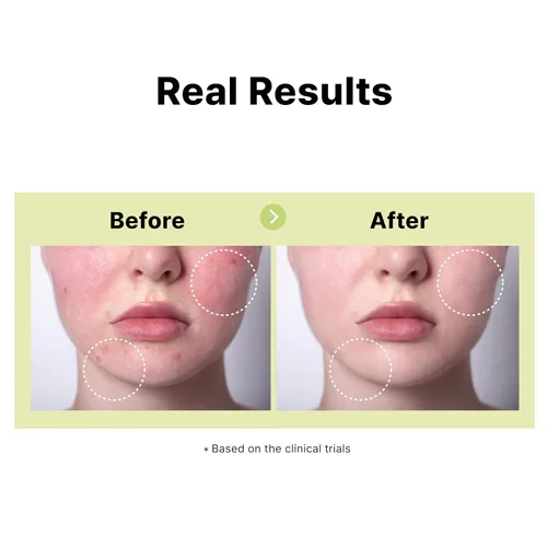 Vista 4 de DearMYDEW Suero de ácido azelaico 10% con niacinamida, ácido salicílico, alantoína, tratamiento de rosácea para aliviar el enrojecimiento facial