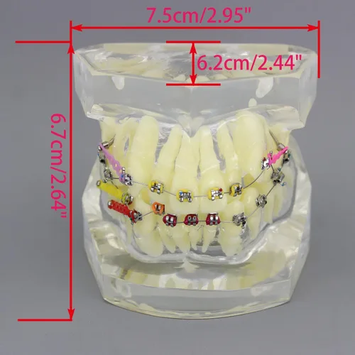 Vista 3 de Modelo dental de los dientes del tratamiento de ortodoncia de la maloclusión con los soportes del metal Alambres Cadenas y aros coloridos