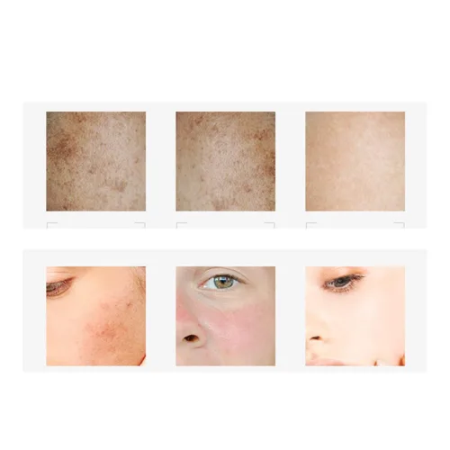 Vista 3 de 1 pieza Isana Pigment Flecken 2 en 1, suero de eliminación de pecas y oscuridad, elimina manchas oscuras y espinillas alrededor de la boca, obtén