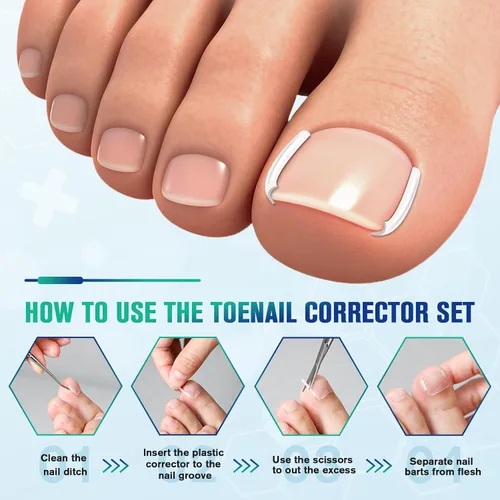 Vista 4 de FERYES Juego de corrector de uñas encarnadas, herramienta profesional de pedicura, 40 tiras alisadoras de uñas encarnadas sin dolor, 50 parches