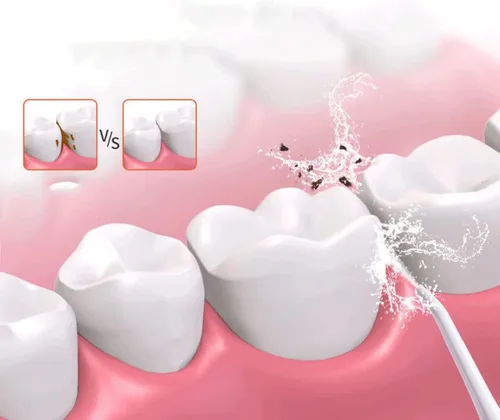 Vista 3 de Irrigador dental inalámbrico avanzado para dientes, encías, aparatos ortopédicos, encías, aparatos ortopédicos, cuidado dental, irrigador oral