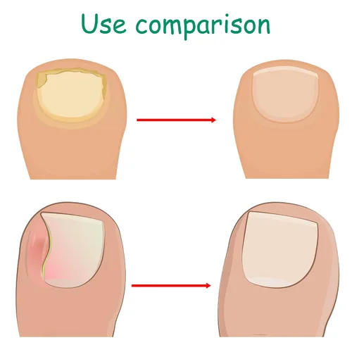 Vista 6 de Kit corrector de uñas encarnadas con tiras de corrección flexibles y cinta – Juego de herramientas profesionales de pedicura en el hogar