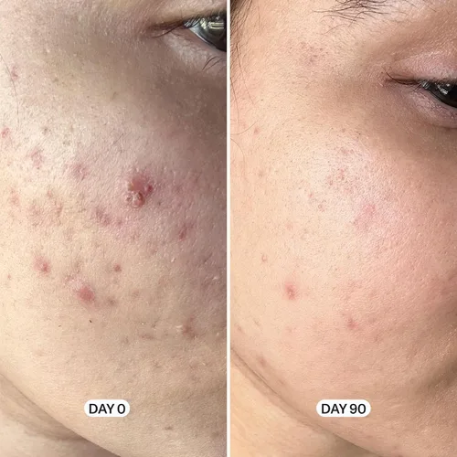 Vista 3 de Geologie Lavado facial con control de acné Limpiador exfoliante de ácido salicílico al 2% Limpia la piel, controla el aceite y previene brotes