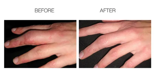 Vista 8 de Elite Advanced Tratamiento de cicatrices, eliminación de cicatrices, terapia de cicatrices, prevención de cicatrices, gel anticicatrices