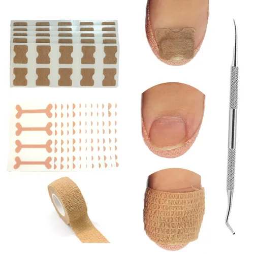 Vista 10 de Tratamiento de uñas encarnadas, 50 parches correctores de uñas encarnadas, calcomanías de corrección de uñas de los pies, herramienta profesional