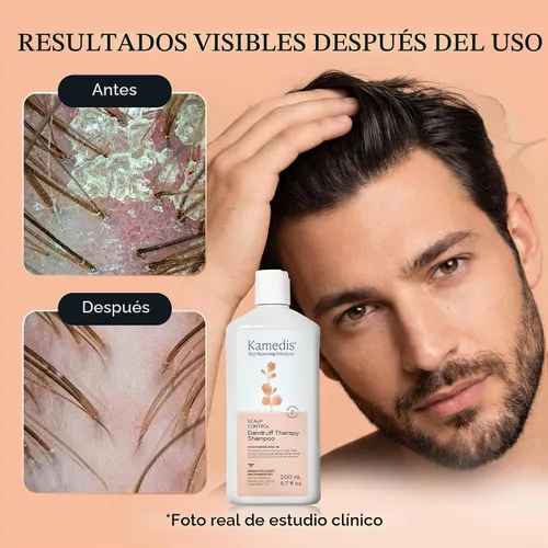 Vista 5 de Kamedis Champú anticaspa para cuero cabelludo sensible y dermatitis seborreica, libre de crueldad, sin parabenos, 6.7 oz