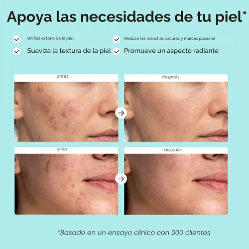 Vista 3 de MAREE Crema facial de ácido azelaico - Tratamiento de ácido azelaico con niacinamida y ácido salicílico - Corrector de manchas oscuras para la cara