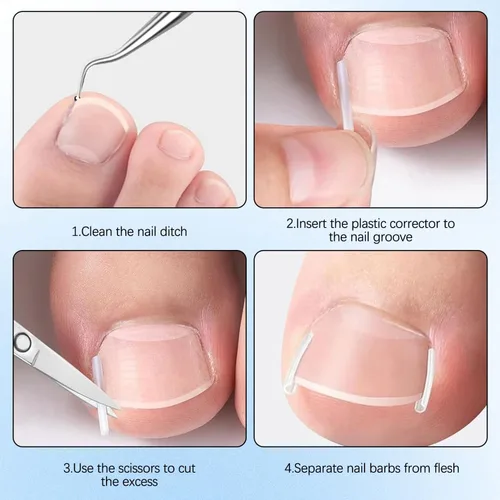 Vista 7 de Kits de corrector de uñas encarnadas con tiras curvas, parches transpirables y herramientas de pedicura, juego de cuidado de uñas para una