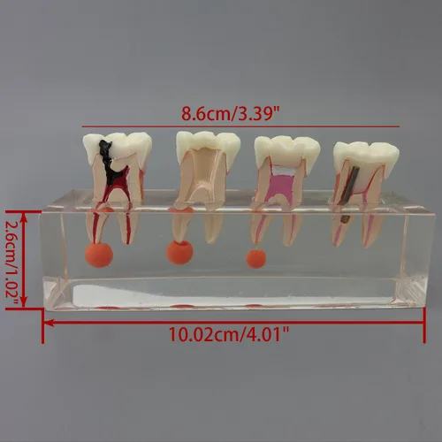 Vista 7 de Modelo de dientes dentales Modelo de tratamiento endodóntico de 4 etapas para estudiar y enseñar..