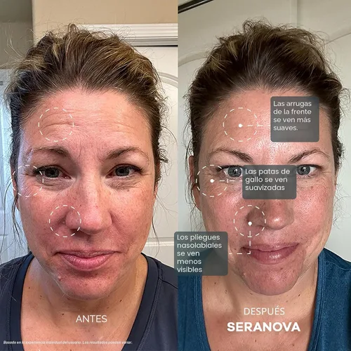 Vista 4 de Seranova Micro Infusión para el Cuidado de la Piel, Esencia Hidratante Facial, Suero Facial para una Piel Lisa para Todos los Tipos de Piel