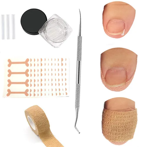 Vista 9 de Tratamiento de uñas encarnadas, 50 parches correctores de uñas encarnadas, calcomanías de corrección de uñas de los pies, herramienta profesional