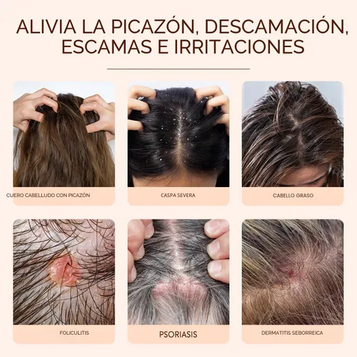 Vista 2 de Champú antifúngico para mujeres Tratamiento de foliculitis: champú para dermatitis seborreica para alivio del cuero cabelludo escamoso