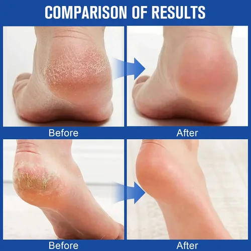 Vista 5 de 3 unidades de crema hidratante y antigrietas para pies, crema de urea de máxima fuerza para pies, loción de pies para talones, manos secas