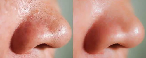 Vista 4 de DrFormulas Reductor de poros y tratamiento de puntos negros con ácido salicílico y niacinamida Limpieza profunda, máscara de acné minimizadora