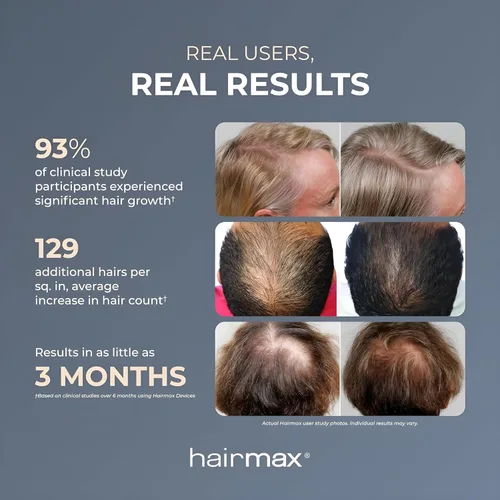 Vista 11 de Hairmax LaserBand 82 - Tratamiento para el Crecimiento y Rebrotes del Cabello - Restaura el Ciclo Natural del Cabello - Dispositivo Médico de Uso