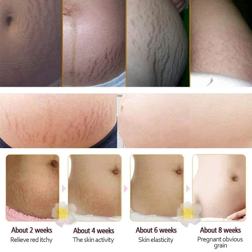 Vista 3 de RtopR Mango Crema para estrías y cicatrices - Crema para estrías y eliminación de cicatrices para el embarazo, la mejor crema hidratante corporal