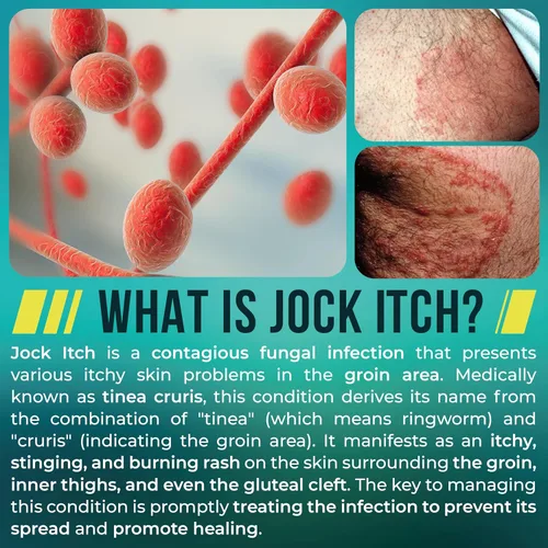 Vista 5 de Jock Itch Cream Tratamiento antifúngico extra fuerte para la ingle y los muslos internos Alivio para la picazón en la piel, tiña inguinal, tiña