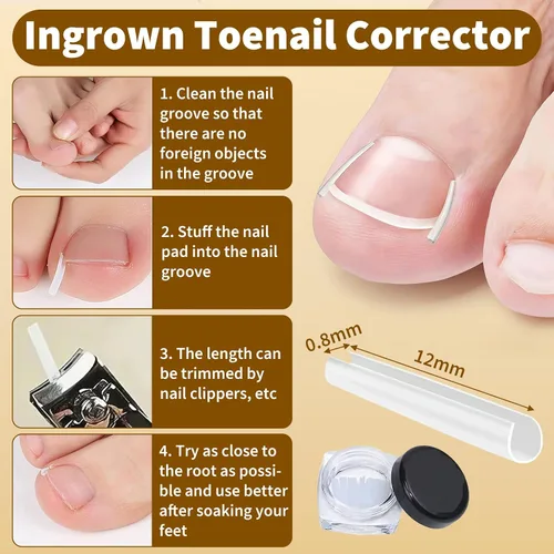 Vista 5 de Juego de corrector de uñas encarnadas con tiras correctoras y lima sin dolor, kit profesional de eliminación de uñas encarnadas con herramienta
