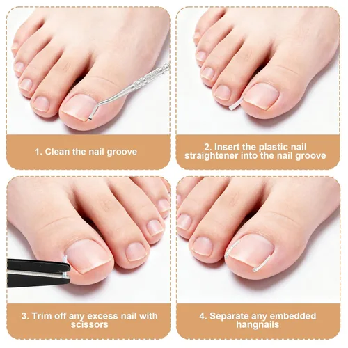 Vista 5 de Kit de 16 piezas de uñas encarnadas, con tiras transpirables para uñas de los pies en crecimiento, corrección de dedos curvos, parches de yeso sin