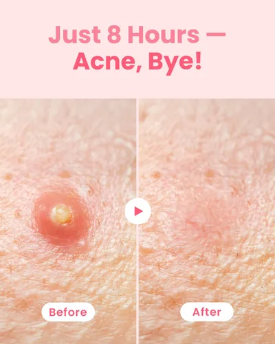 Vista 3 de GLAM UP Parches hidrocoloides para manchas de espinillas – Adhesivos invisibles ultrafinos para cara y piel, fuertes a prueba de agua y adhesivo