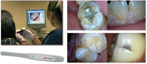 Vista 5 de FocusDent Cámara intraoral dental MD740 - Fácil conexión USB, 6 LED, 1.3 megapíxeles - Software dental incluido!